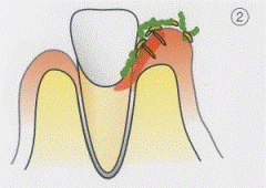 歯周病の進行2