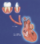お口の細菌が心臓の病気に関係