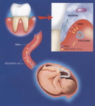 お口の細菌が低体重児出産に関係