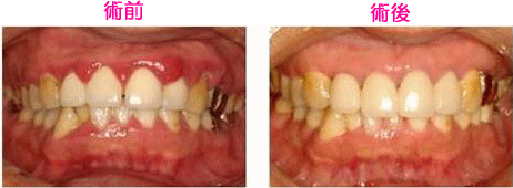 歯周内科治療による お口の中の変化